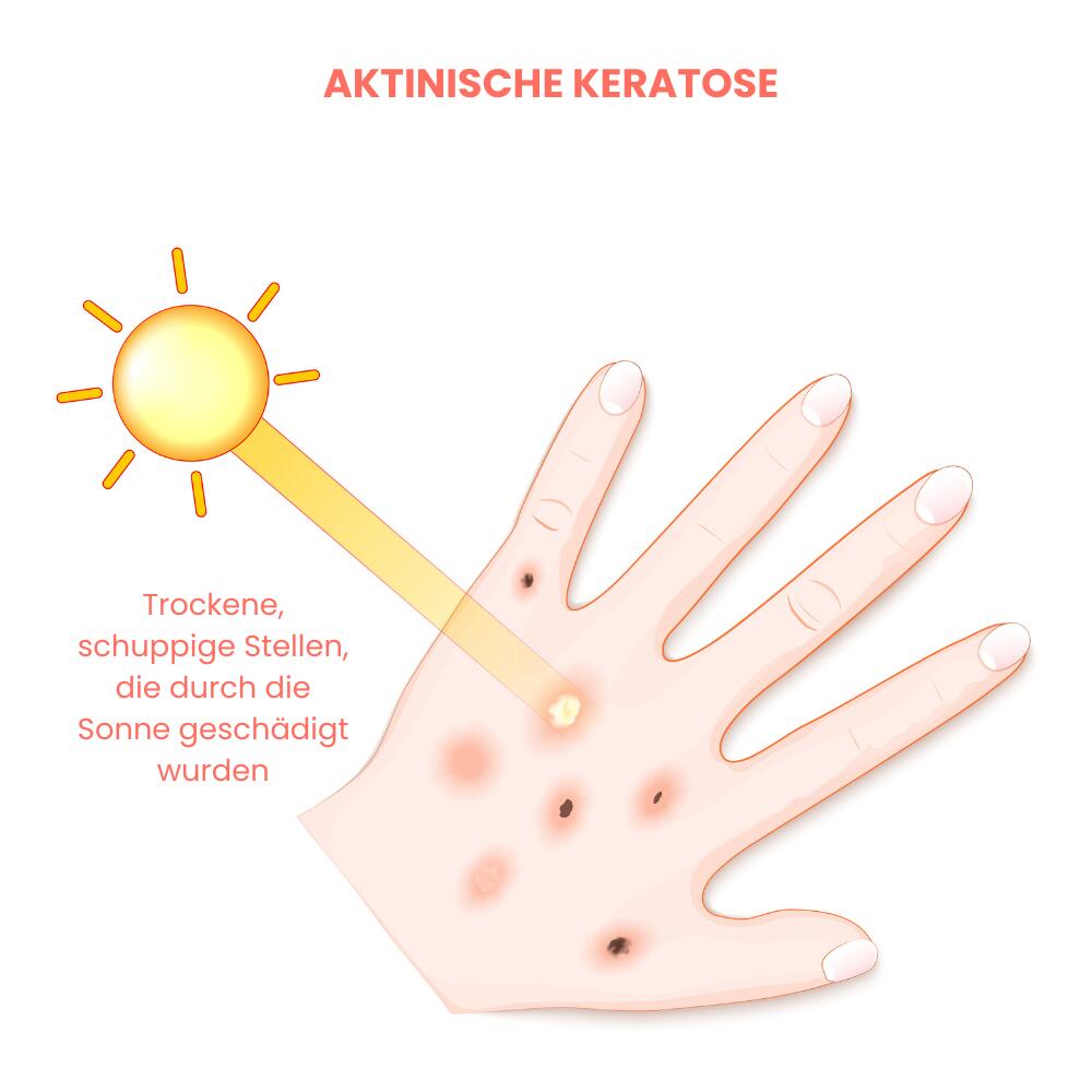 Illustration einer Hand mit mehreren rauen, schuppigen Hautstellen auf dem Handrücken, die durch langjährige Sonneneinstrahlung verursacht wurden.